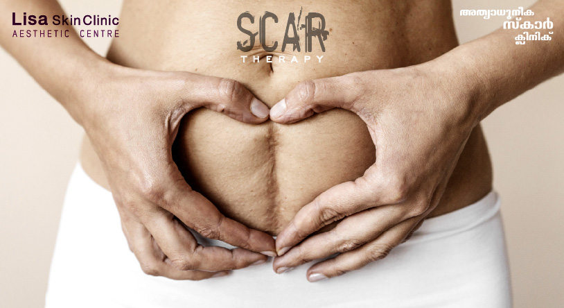 scar therapy for acne scar using non surgical energy based protocols for Melasma, Acne Scars, Skin Aging, Scars and Keloids, Warts at signature aesthetic centre in calicut by board certified dermatologist certified by A4M - American Academy of Anti-Aging Medicine